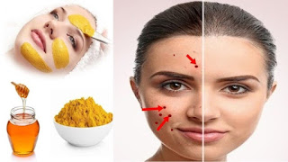 Home Remedies for AcneTreatments