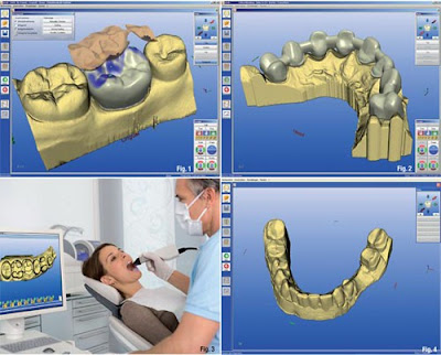 Tiết kiệm thời gian và chi phí cấy ghép Implant