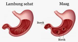 Maag Akut Dan Kronis