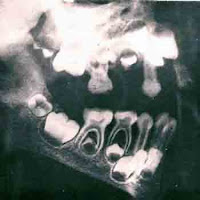<Img src ="ortopantomografía-5-años.jpg" width = "350" height "350" border = "0" alt = "Formación de los dientes a los cinco años">