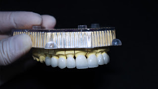 Răng sứ không kim loại giá bao nhiêu-1