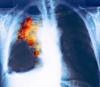 Lug cancer statistics
