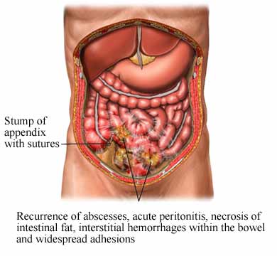 inflamed taste bud. membrane becomes inflamed.