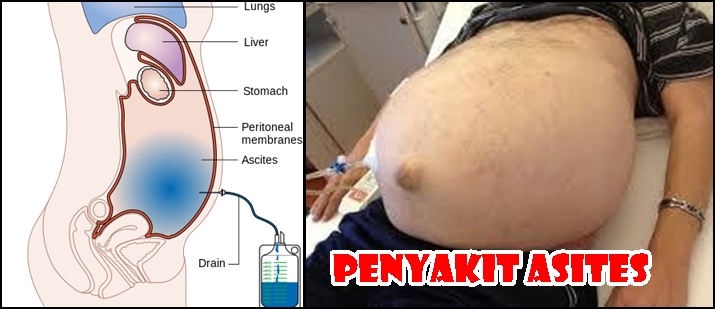 Cara Mengobati Asites Atau Busung Air Secara Alami