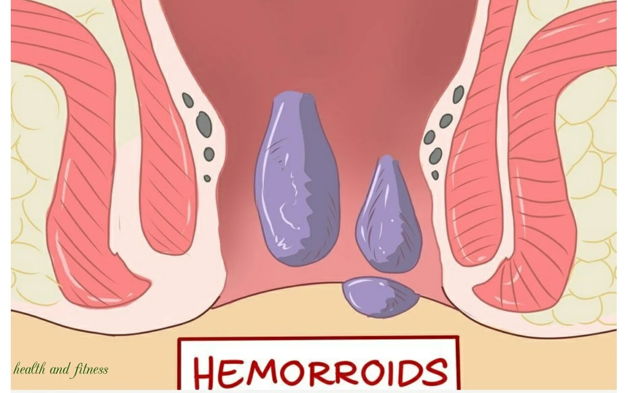 Methods of treating hemorrhoids