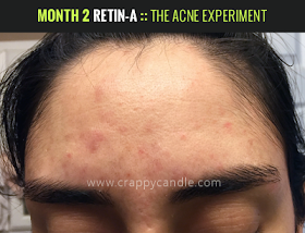 Month 2 on Retin-A :: The Acne Experiment
