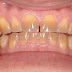Răng nhiễm màu nặng nên tẩy trắng hay bọc răng sứ?