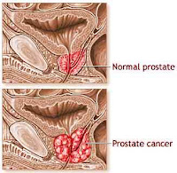 Kanker Prostat