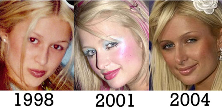 before and after nose jobs celebrity before and after nose jobs celebrity