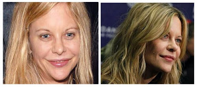 Meg Ryan Plastic Surgery