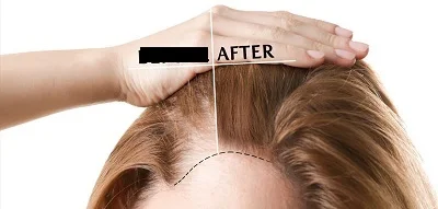 how to hair transplant for women