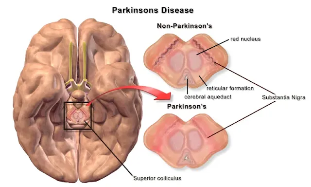 managing parkinson's, parkinson's wearable technology, Parkinson's tracking watch, parkinson's and technology, parkinson's disease