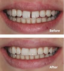 Can you close your teeth gaps without braces?