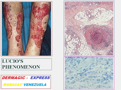 Lepra lepromatosa y fenómeno de Lucio