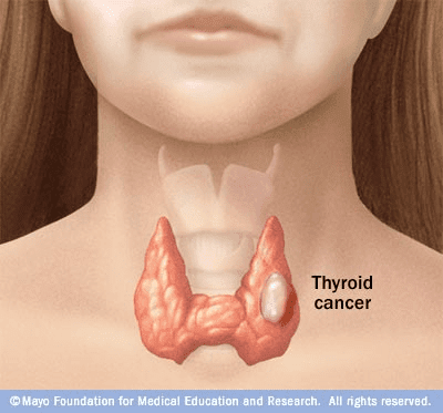 causes-of-thyroid-cancer