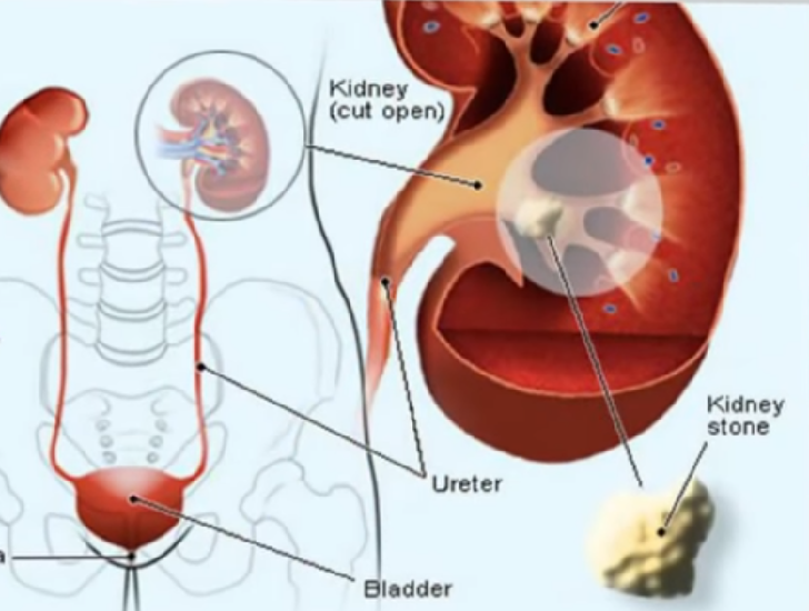 Kidney Stone