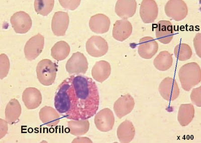 plaquetas y un eosinófilo rodeado de eritrocitos