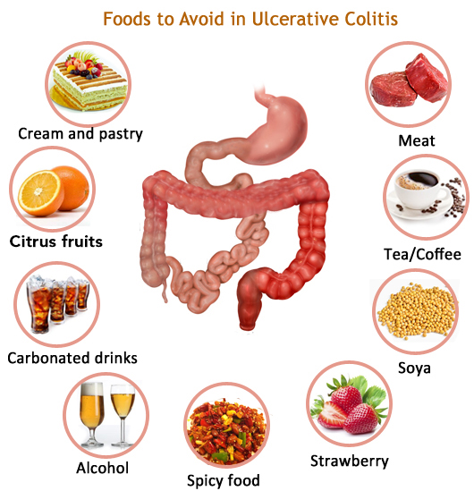 Ayurvedic treatment of Ulcerative colitis - Dr. Vikram's Blog