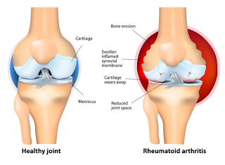 Rheumatoid Arthritis Diagram