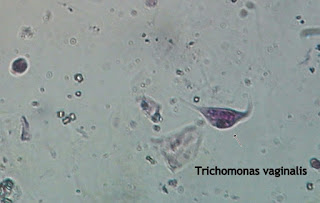 Trichomonas Vaginalis.