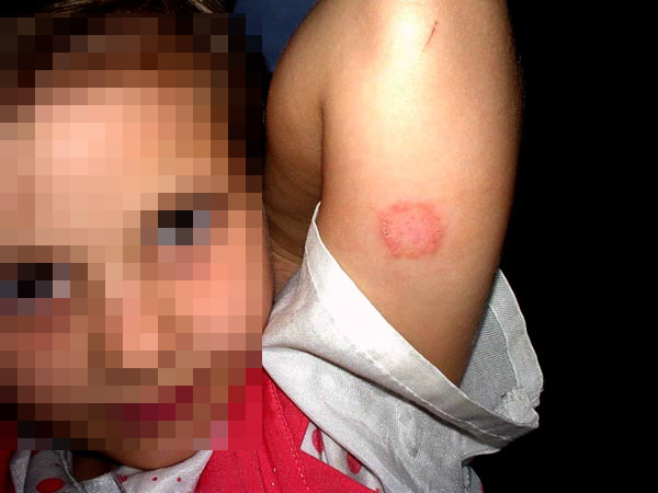 treatment for ringworm. Ringworm is making a big