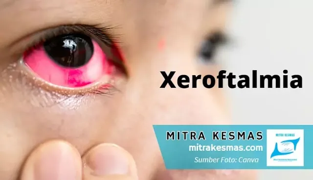 xeroftalmia