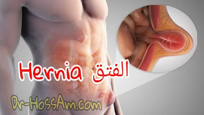 ما هو الفتق Hernia