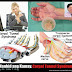 Carpal Tunnel Syndrome dulot ay pamamanhid