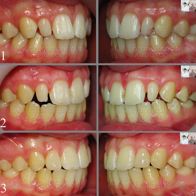  Фото до и после лечения  зубов с аномалией формы