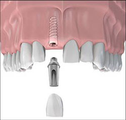 Trồng răng Implant là gì?