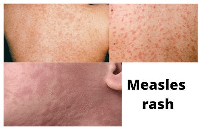 Measles (Rubeola)