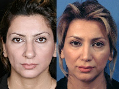 Interesting Before and After Nose Surgery Seen On www.coolpicturegallery.us