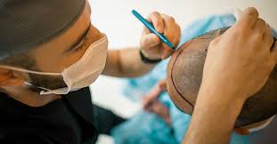 Best hair transplant in delhi