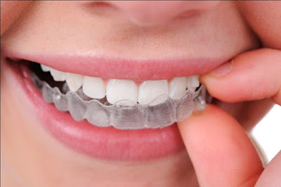 Niềng răng không nhổ răng với mắc cài Invisalign