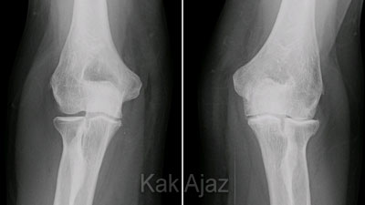 Pembahasan Biologi UN 2018 No. 16 - 20, gangguan sistem gerak, persendian, osteoarthritis