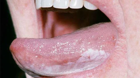 causes of tongue cancer