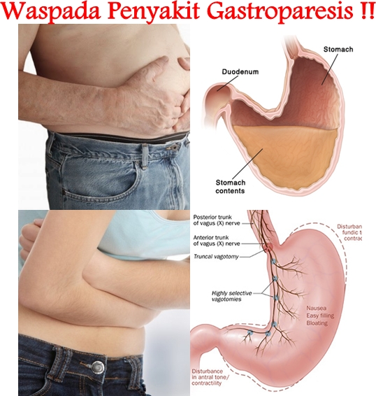 Pengobatan Tradisional Gastroparesis