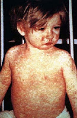 Number Of Measles Cases Rise To 230