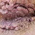 Obat Kutil Kelamin Di Anus thumbnail