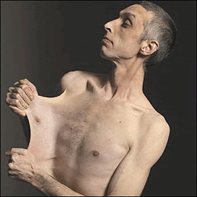 Elhers Danlos Syndrome Garry Turner Stretchiest Skin Guinness World Record