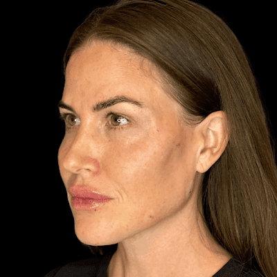 lip fillers in Bend Oregon