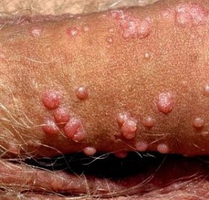 Penyebab Virus Kondiloma