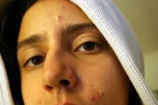 What Kind OfWhat Type of Acne Do You Have?Acne Do You Have And How To Tell