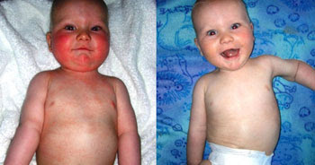 eczema natural remedy for baby