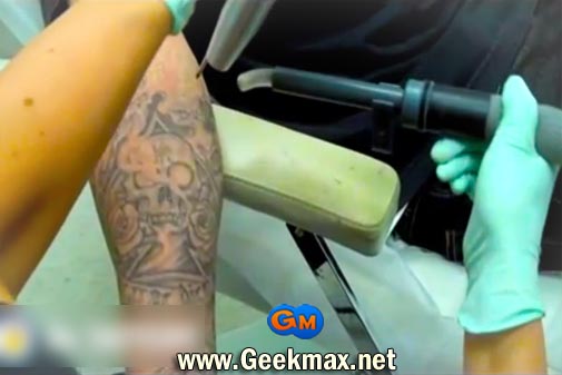 Tattoo Removal Michigan