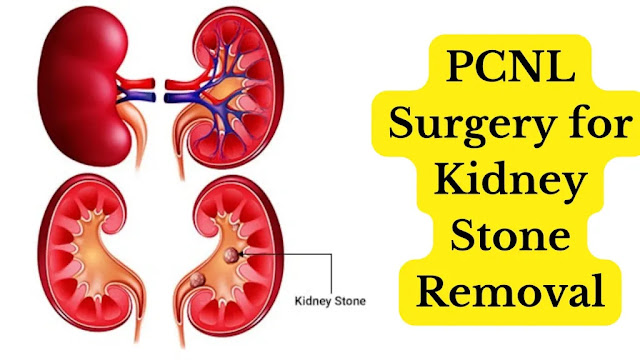 Kidney Stone Surgery in Delhi, Kidney Stone Surgery Cost in Delhi