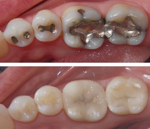 Tùy vào từng vị trí của răng để lựa chọn vật liệu trám phù hợp