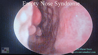 cold turbinate,ENS,Nasal physiology,Empty Nose Syndrome,healthy turbinates,Nasal Hyperventilation,