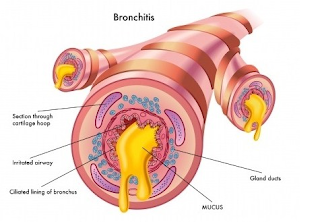 Cara Mengobati Penyakit Bronkitis