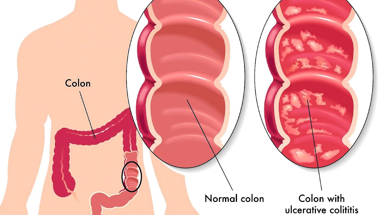 Ulcerative colitis - Ulcer Colitis